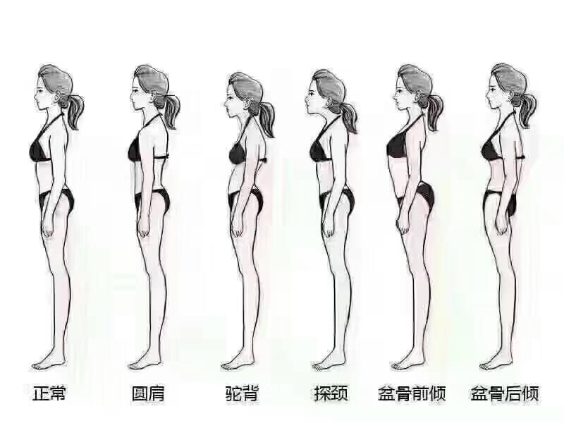 人体骨盆错位,骨盆前倾的危害