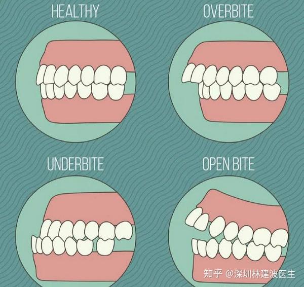 自测你的牙齿咬合关系正常吗牙齿咬合不良的危害你知道吗如何纠正不良