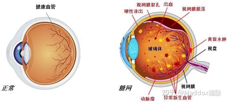 警惕糖尿病视网膜病变