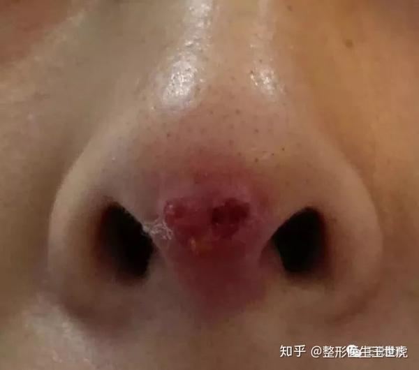 成都哪里可以做线雕隆鼻