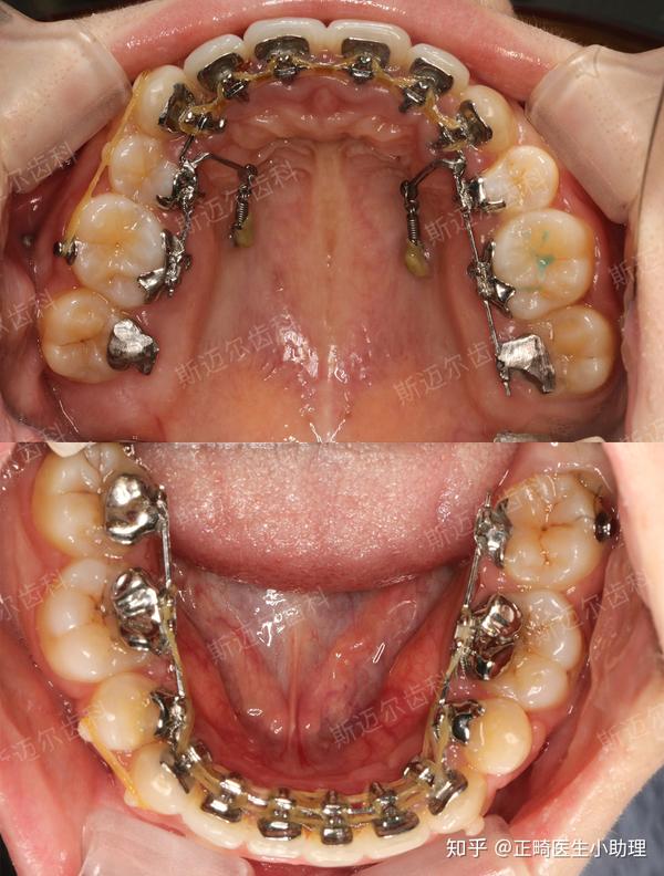 打完骨钉后,牙齿内收的效果更明显了,肉眼可见的变化.