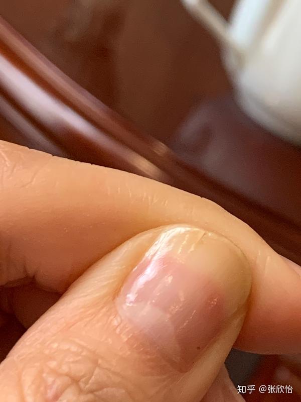 大拇指指甲有白色竖纹5年了,今年从竖纹出经常裂开,求助.