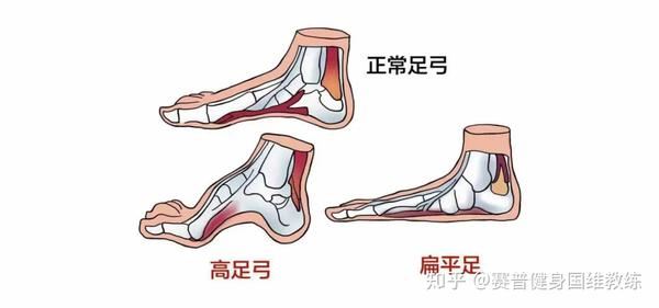 训练干货丨你的扁平足可真不好看啊!(脚底疼痛怎么解决)