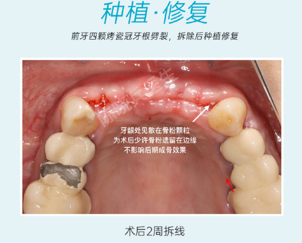 广州多牙种植-【前牙四颗烤瓷冠牙根劈裂,拆除后种植修复】