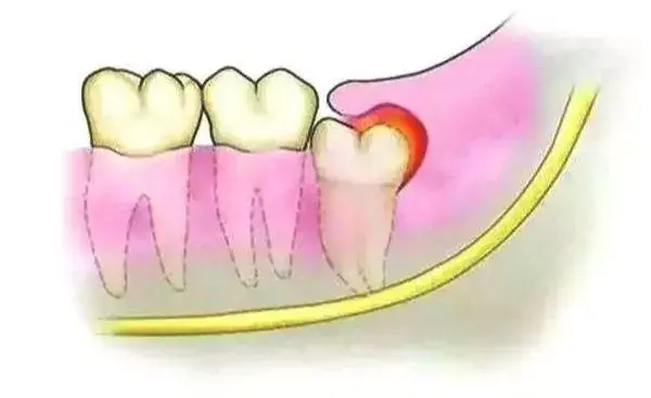 当智齿没有完全萌出,不在正常的位置时,牙冠周围的软组织产生炎症