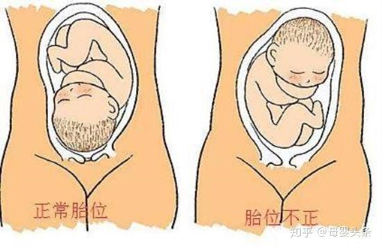 胎位是否正常关系到胎儿的分娩方式,胎位的写法由这3种情况:(1)描述
