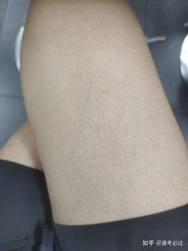 为什么一个女生会长这么多毛 真的好自卑啊 感觉每个毛孔都有毛 真的