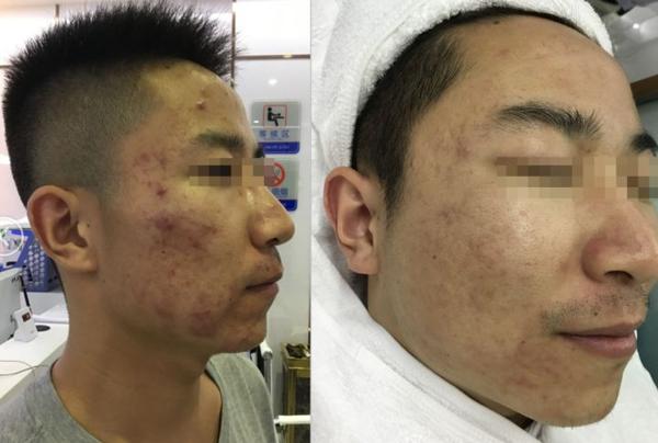 螨虫脸囊肿痘过敏痘激素脸脓包痘美国人用什么方法祛掉这些痘痘的