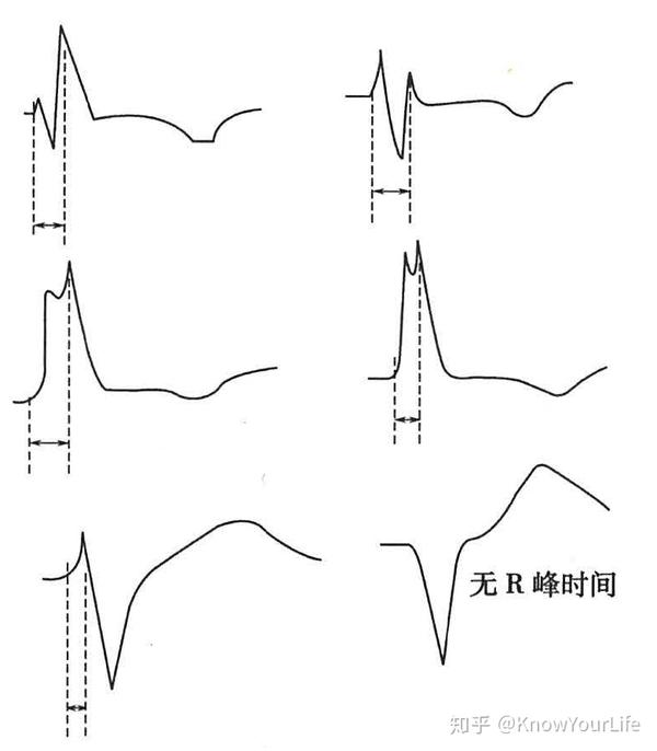 【史上最全医学科普7】心电图怎么看