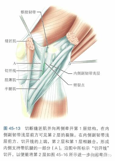 膝关节的主要稳定结构, 内侧四联复合体(内侧副韧带,半膜肌,鹅足肌腱