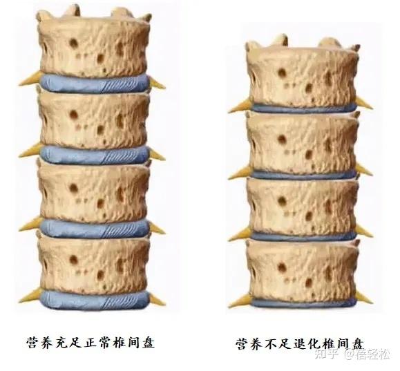 椎间盘就退变 没有血管了,其日常营养供给只能靠周边体液慢慢 渗透.