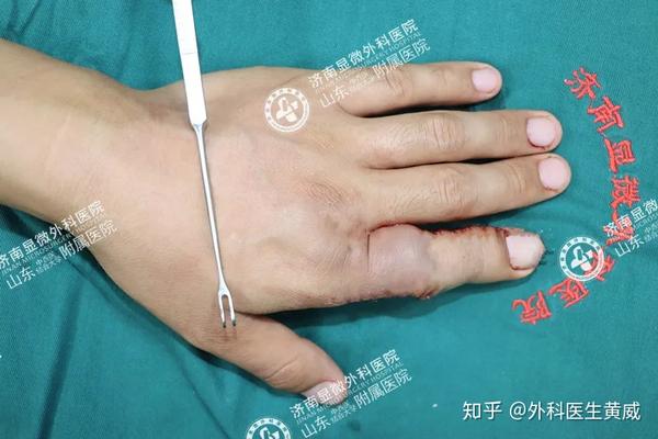 手指意外被皮带绞伤15年,形成示指中,远节指骨残缺,左手示指一向不