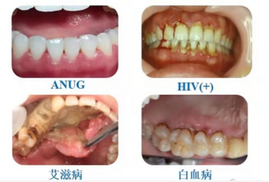 刷牙出血,牙龈肿痛怎么办?