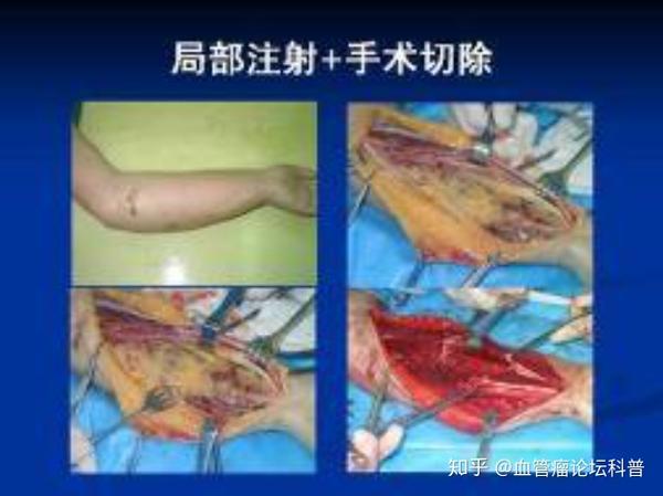必看血管瘤与脉管畸形特色诊疗方法全解