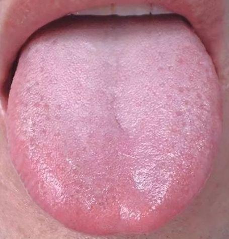 呈粉红色,表面润泽 干湿适度,舌苔薄白且均匀. 齿痕