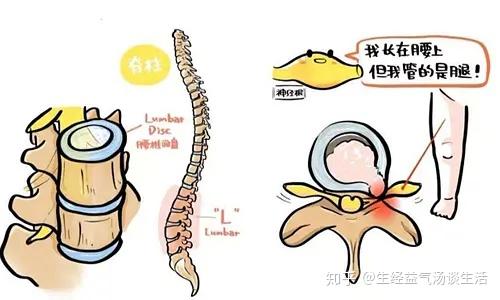它的另一个名字叫做"马尾神经损伤"