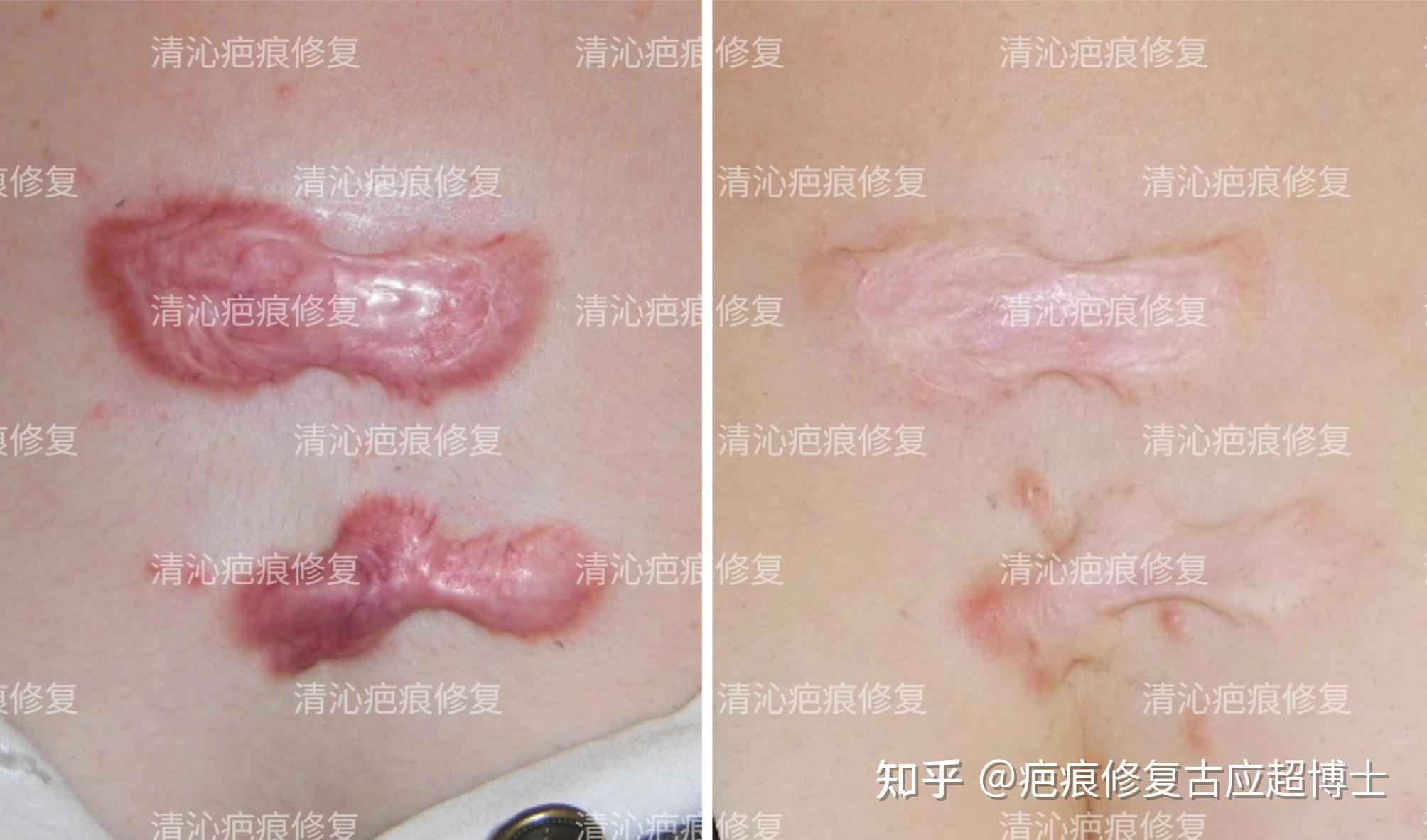 疤痕体质真的好痛苦,胸口和后背肩膀两边都是疤痕疙瘩