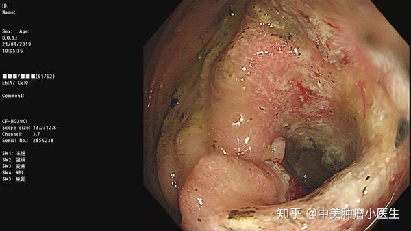 多年便秘苦恼不堪,肠镜一做,竟然是结肠癌