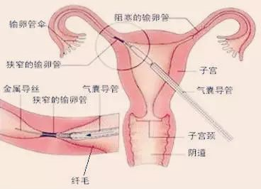 输卵管通水后还是堵!原因是