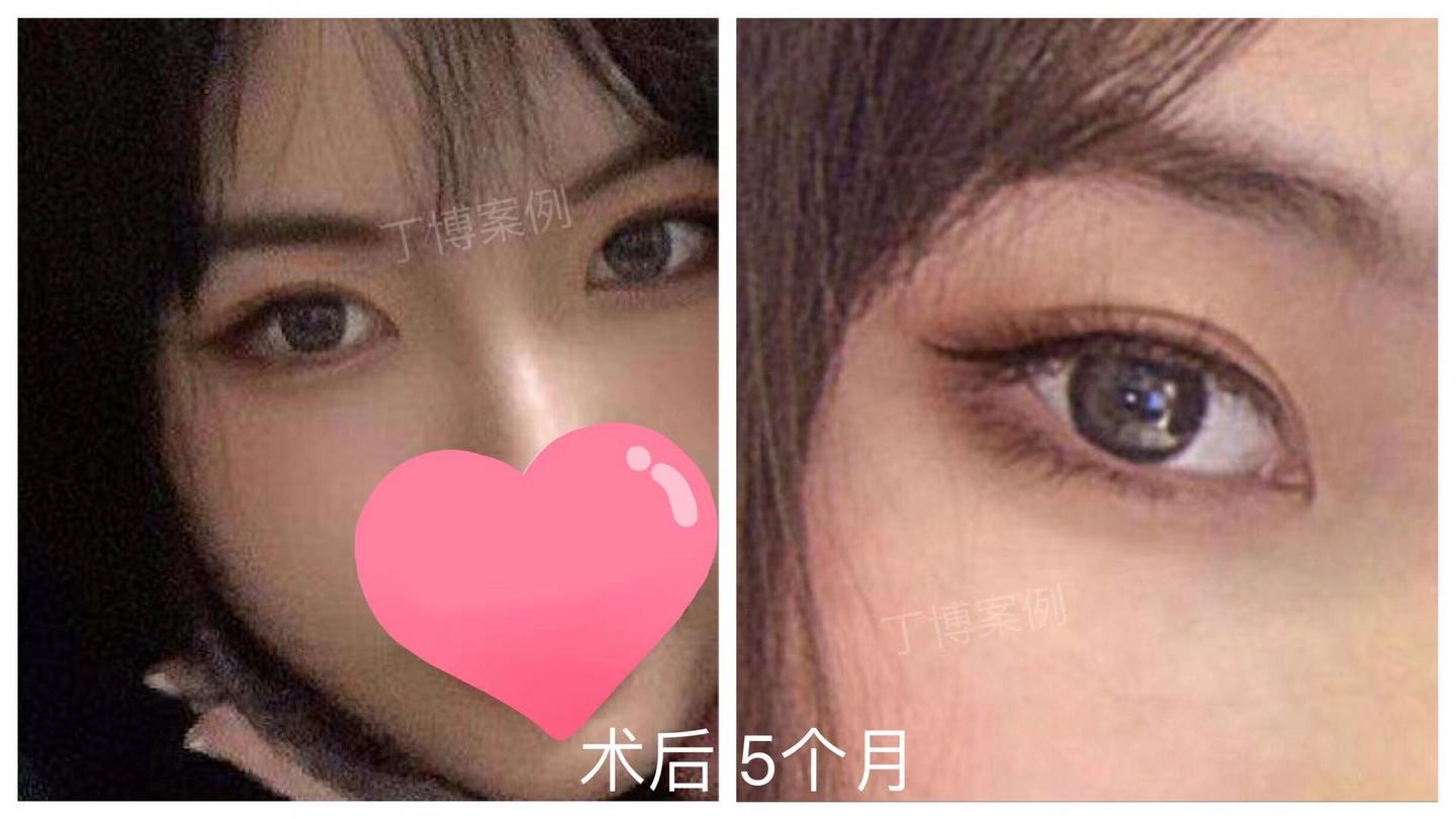 三点式双眼皮(北京医院丁金萍)系列案例六十四