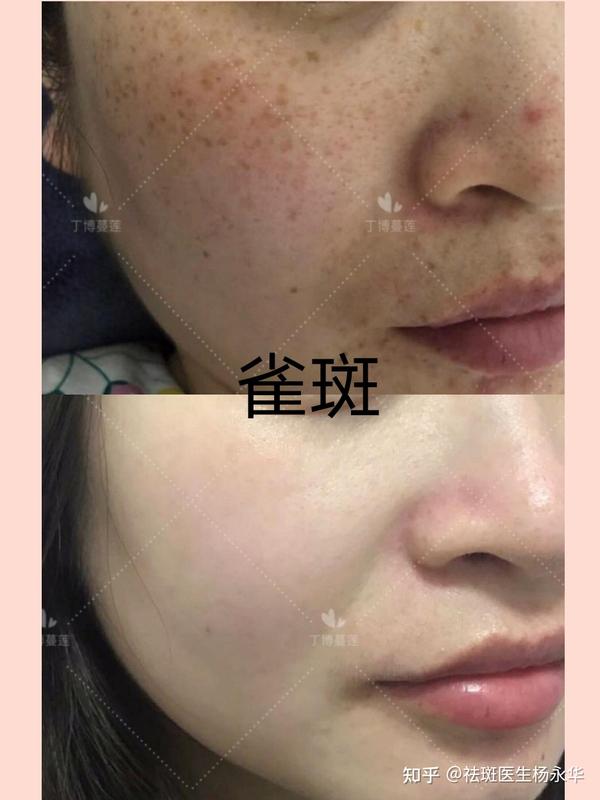 雀斑样痣:6个月左右