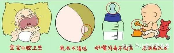 鹅口疮是指口腔黏膜感染 白色念珠菌后婴儿的口腔黏膜出现散
