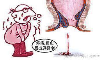 痔疮出血严重吗 zhuanlan.zhihu.com
