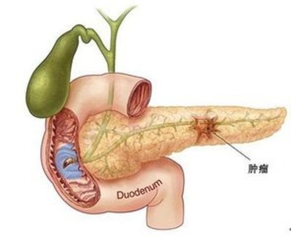 胰腺癌治疗 为你讲解什么是胰腺癌