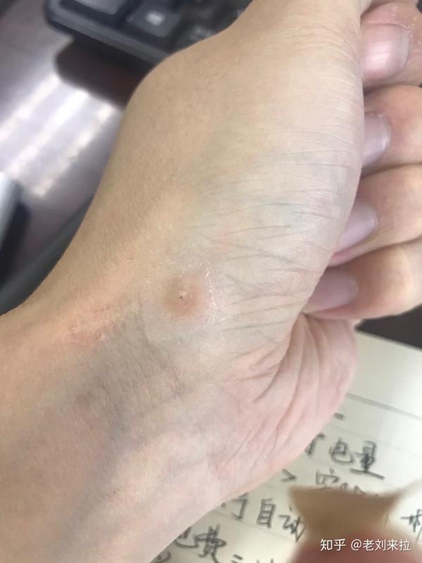 我治愈了结节性痒疹