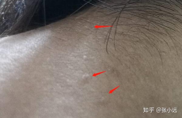 如何去除扁平疣