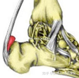 跟腱滑囊炎,也称为跟