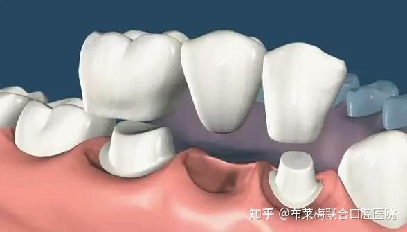 2,常见方式:固定假牙  比活动假牙舒适,需磨少量健康牙  优点:体积小