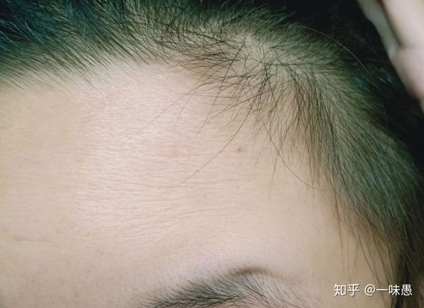 鬓角的毛长了,而且另一边张出了一些小绒毛,忘拍了,看不出来但是可以
