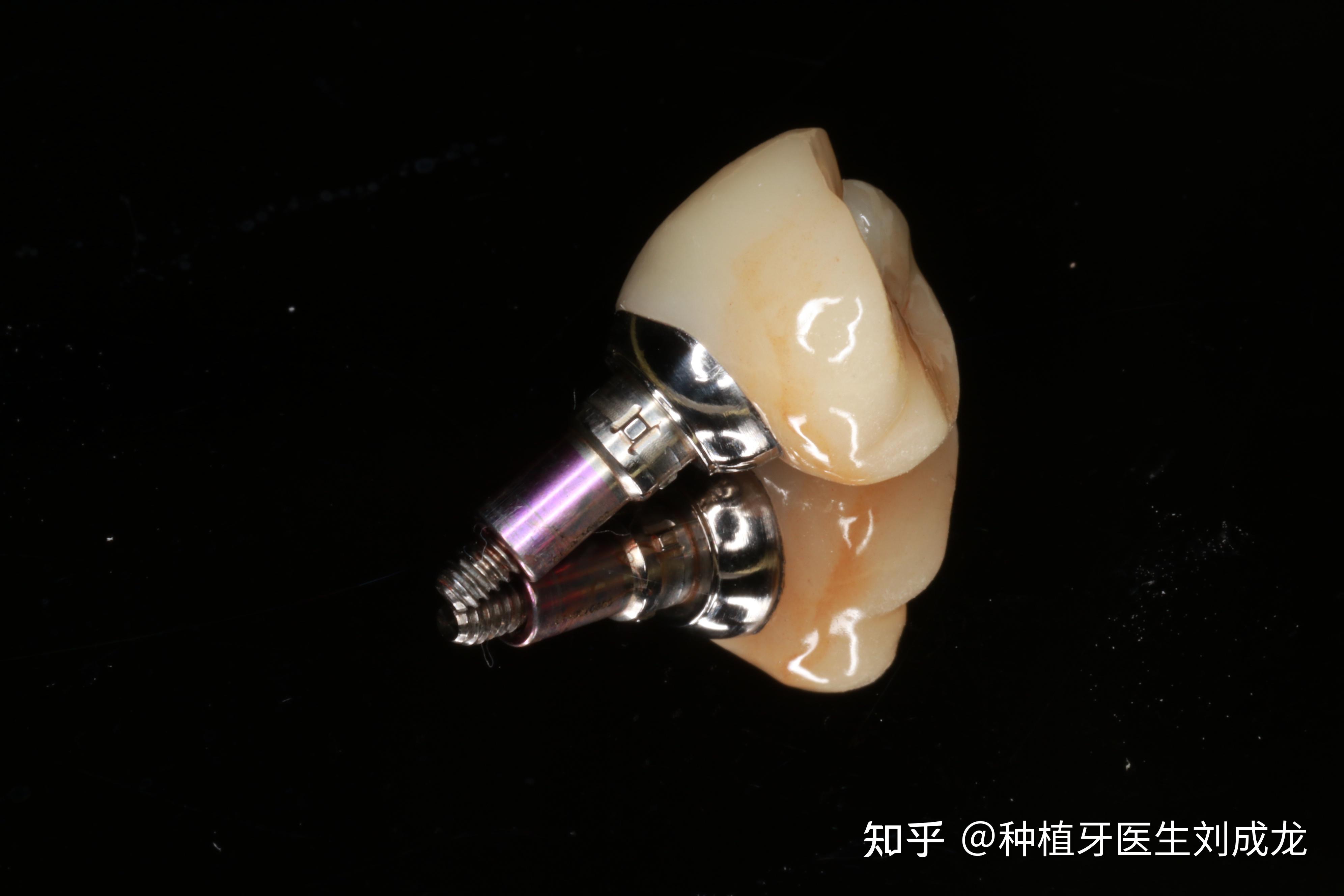 郑州种植牙下颌单颗德国camlog种植修复案例
