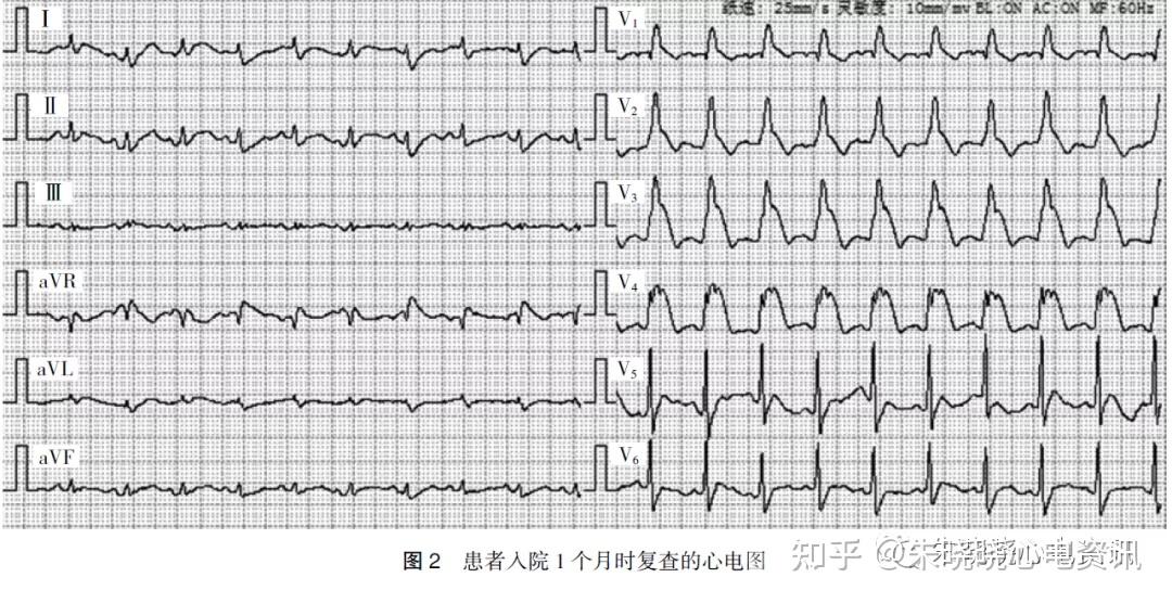 (3)完全性右束支传导阻滞;(2)肢体导联低电压;(1 )窦性心动过速;入院1