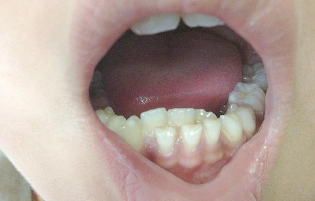 双排牙在口腔医学中被称为乳牙滞留,是指孩子进入换牙期后,由于乳牙