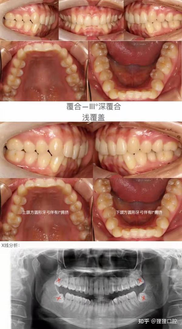 上前牙覆盖下前牙长度的三分之一以上就是深覆合,一起来看看这位深覆