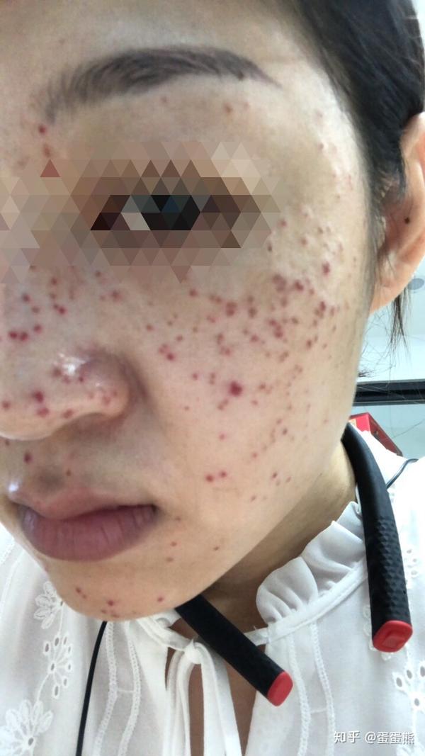 皮秒祛斑加有创水光全记录