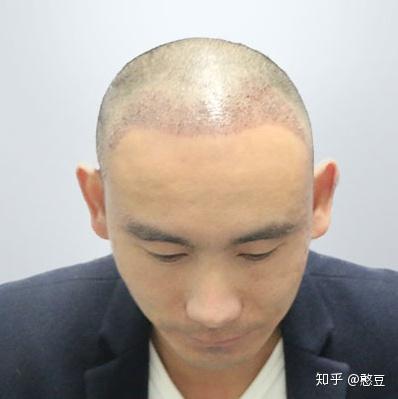 【天津植发】男子头顶加密植发案例分享