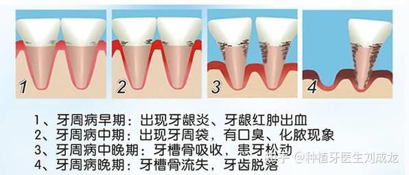 常见的牙周病包括:牙龈炎和牙周炎.