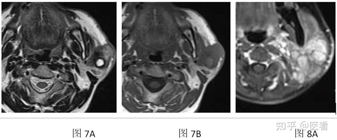 4a 左侧腮腺导管细胞癌,t2部分呈低信号,内部见小圆形高信号区,瘤体