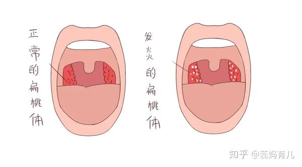 孩子喉咙发炎在家自己搞定食养方特定穴预防胜过割除