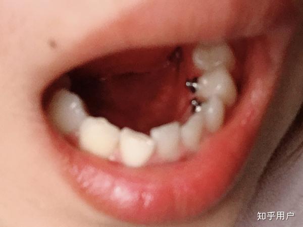 大龄女青年,牙齿正畸并拔牙的过程和感觉?