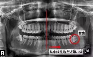 智齿部位肿痛后怎么办?