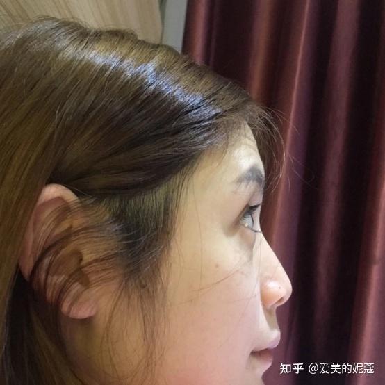 塌鼻子隆鼻效果明显天津真实案例 选网红鼻还是自然鼻