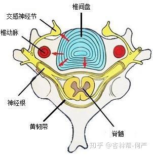 类型的颈椎病是最多见的,是因为向后方突出的椎间盘或骨刺压迫神经根