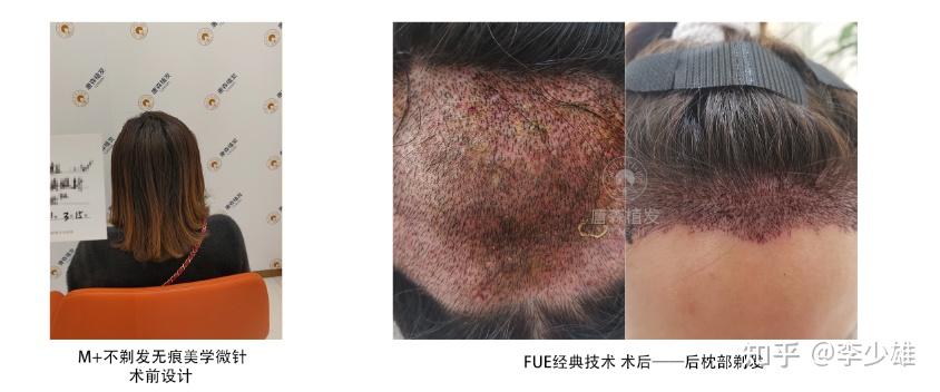 雄哥植颜植发一定要剃发吗