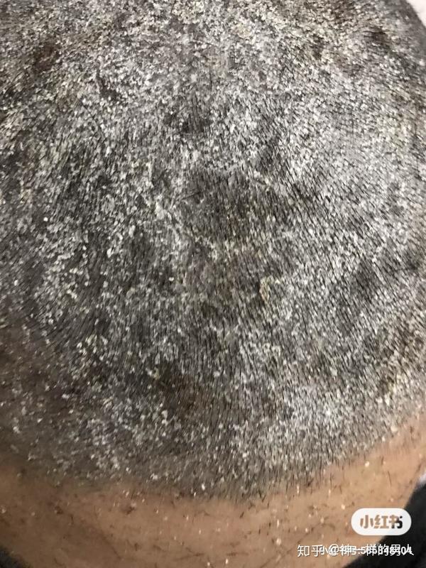 头皮牛皮廯头皮屑头皮痒困扰很多年了,头皮牛皮廯头皮