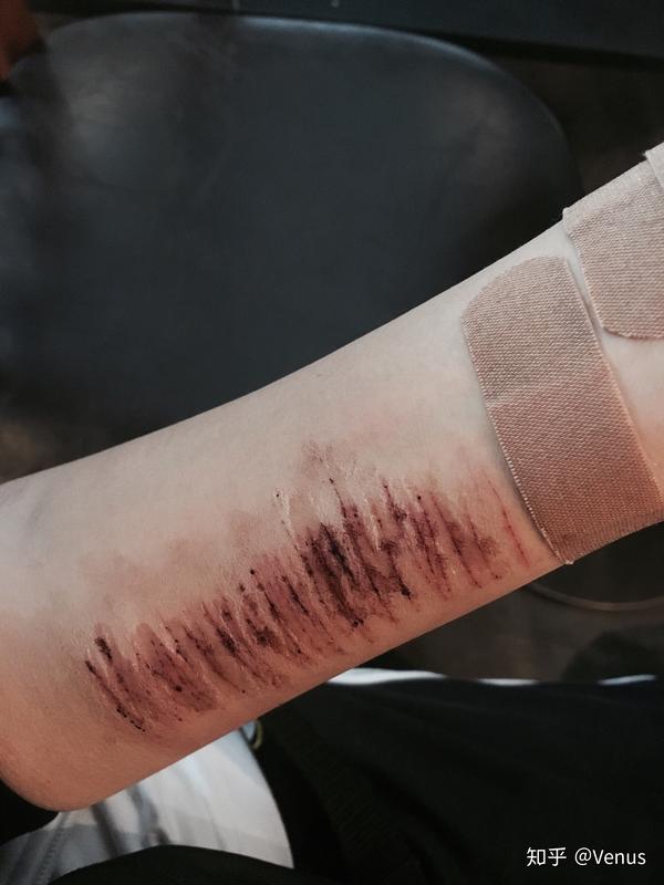 为什么抑郁症患者总选择割腕的方式自残?