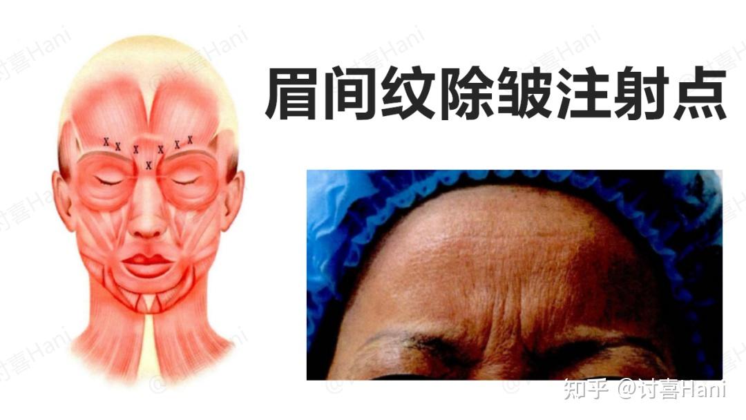 是由额肌,降眉肌和眼轮匝肌内侧缘肌肉引起的纵行纹,产生于喜欢皱眉头